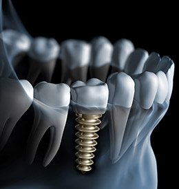 Animation of implant supported dental crown
