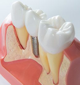 Model smile with implant supported dental crown