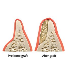 Animation of the bone grafting process