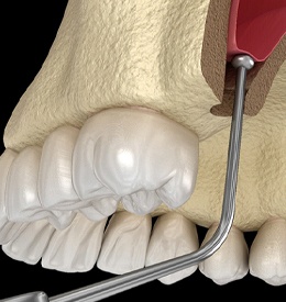 illustration of dental instrument gently pushing sinus upward