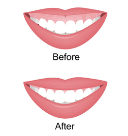 Illustration of smile before and after esthetic crown lengthening