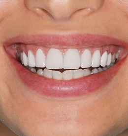 Closeup of perfected smile