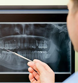 Dental x-rays
