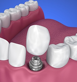Animation of implant supported dental crown placement