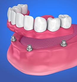 Animation of implant supported denture placement