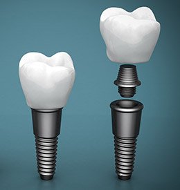 Animation of the implant supported dental crown process