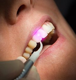 Closeup of patient receiving soft tissue laser treatment