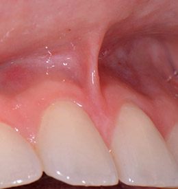 Closeup of excess tissue between the gums and lips