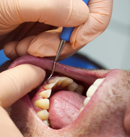 A man having dental work performed on his mouth
