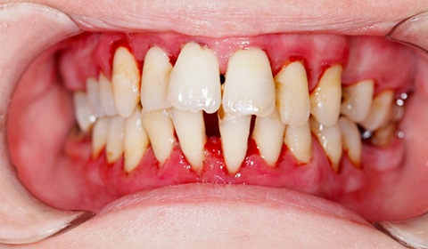 mouth with gum disease