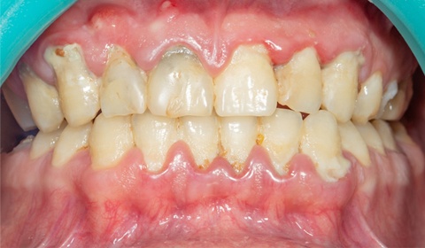 patient with gum disease