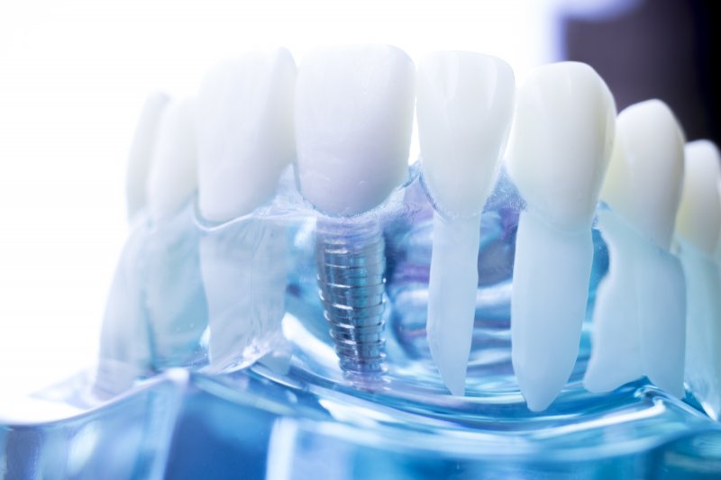 Complex Dental Implants in Towson Melody D. Ward DDS