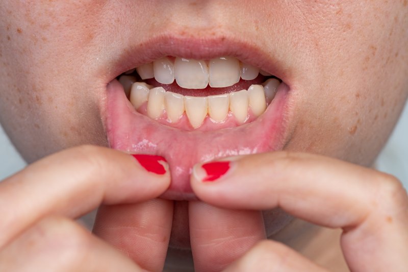 Gum Grafting in Towson Periodontics Melody D. Ward DDS