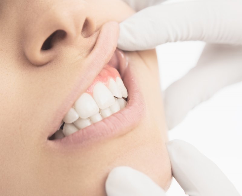 Periodontist in Severna Park checking woman’s gums