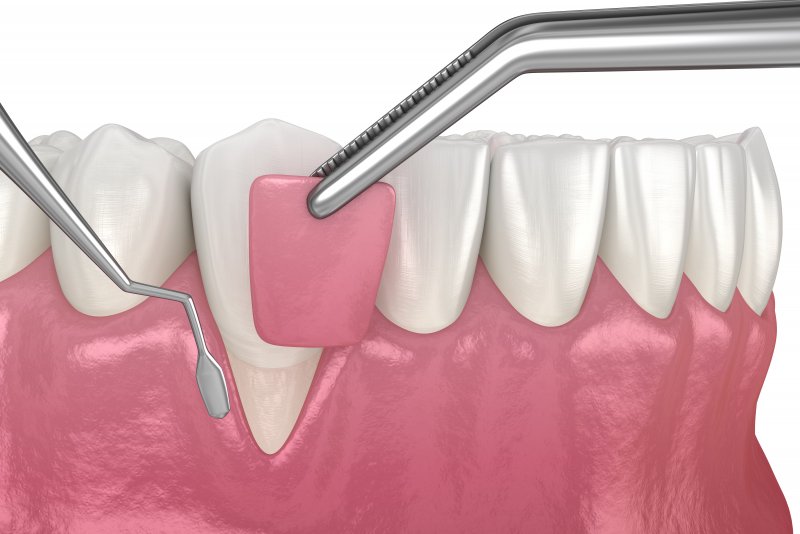 Illustration of a gum graft performed for gum recession
