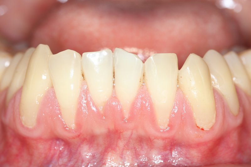 Close-up of lower arch of teeth with receding gumline
